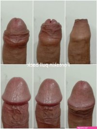 dicks foreskin
