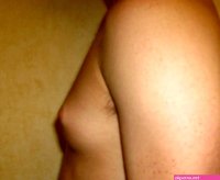 Male breast reduction