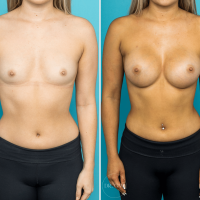 Returning To Exercise After Breast Augmentation Surgery
