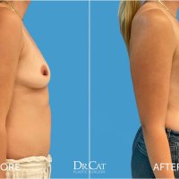 Breast Augmentation: Before During and After Surgery