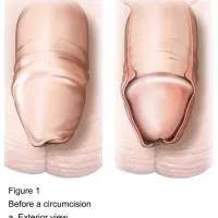 Circumcision