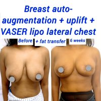 Breast Lift Procedure