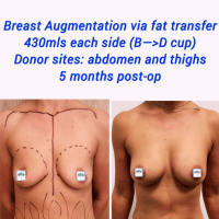Fat Transfer Breast Augmentation: How Many Cup Sizes Can You Increase?
