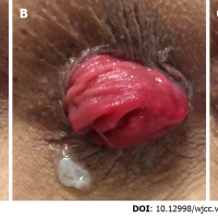 Current diagnostic tools and treatment modalities for rectal prolapse