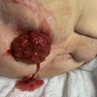 Large Anal Polyp Disguised as Rectal Prolapse