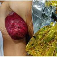 Perineal Rectosigmoidectomy Altemeiers Procedure in the Treatment of Strangulated Rectal Prolapse: A Case Series and Literature Review