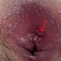 Anal Canal Duplication With Abscess Formation and Associated Sacrococcygeal Hamartoma in an Adolescent: A Report of a Rare Case