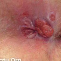 Anal cancer image