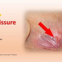 Anal Fissure