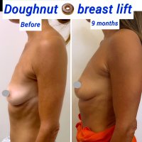 Mastopexy for Small Breasts: 5 Facts You Need to Know