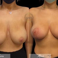 BBL and Breast Augmentation