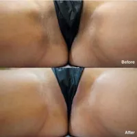 What is Vaginal Bleaching and Anal Bleaching