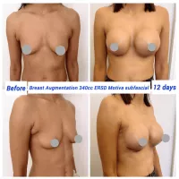 The Ideal Boob Job: The Art and Science of Choosing the Best Breast Implants for You