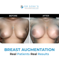 5 Best Possible Ways to Recover Post Breast Augmentation Surgery