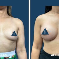 Breast Implants Plano