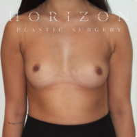 BREAST AUGMENTATION