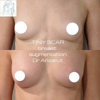 Introducing the Tiny Scar Breast Augmentation with a SNAP recovery