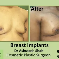 Small Boobs in Female Solution in Ankleshwar Bardoli Kim Surat Gujarat