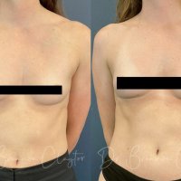 Mini Breast Aug: What It Is Why Everyones Talking About It