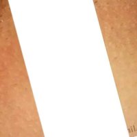 Anal Skin Tags Lake Success Queens Long Island NY