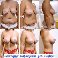 4 Benefits of Combining a Tummy Tuck and Breast Surgery
