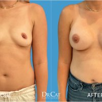 Saline vs. Silicon Breast Implants