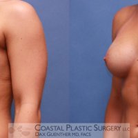 Saline vs. Silicone Implants: Which Is Right for Your Breast Augmentation?