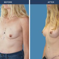 Should I Replace Saline with Silicone Implants? Anthony MacQuillan Plastic Surgeon
