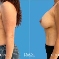 Saline vs. Silicon Breast Implants