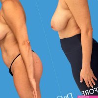How Breast Lift and Breast Reduction Can Help Large Breasts