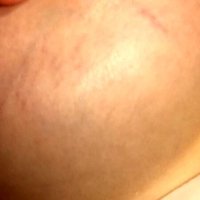 TMI Stretch Marks on Boobs?