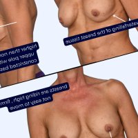 What Causes Breasts To Harden After Breast Augmentation?