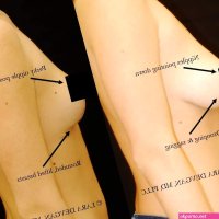 Breast lift mastopexy to restore the breasts to a perky position Lara Devgan MD MPH FACS