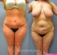 Tummy Tuck Abdominoplasty Before and After Pictures Case 36