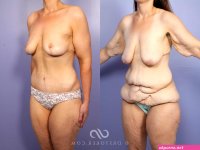 After Weight Loss Before and After Photo Gallery