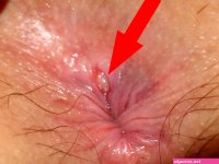 Anal fissure