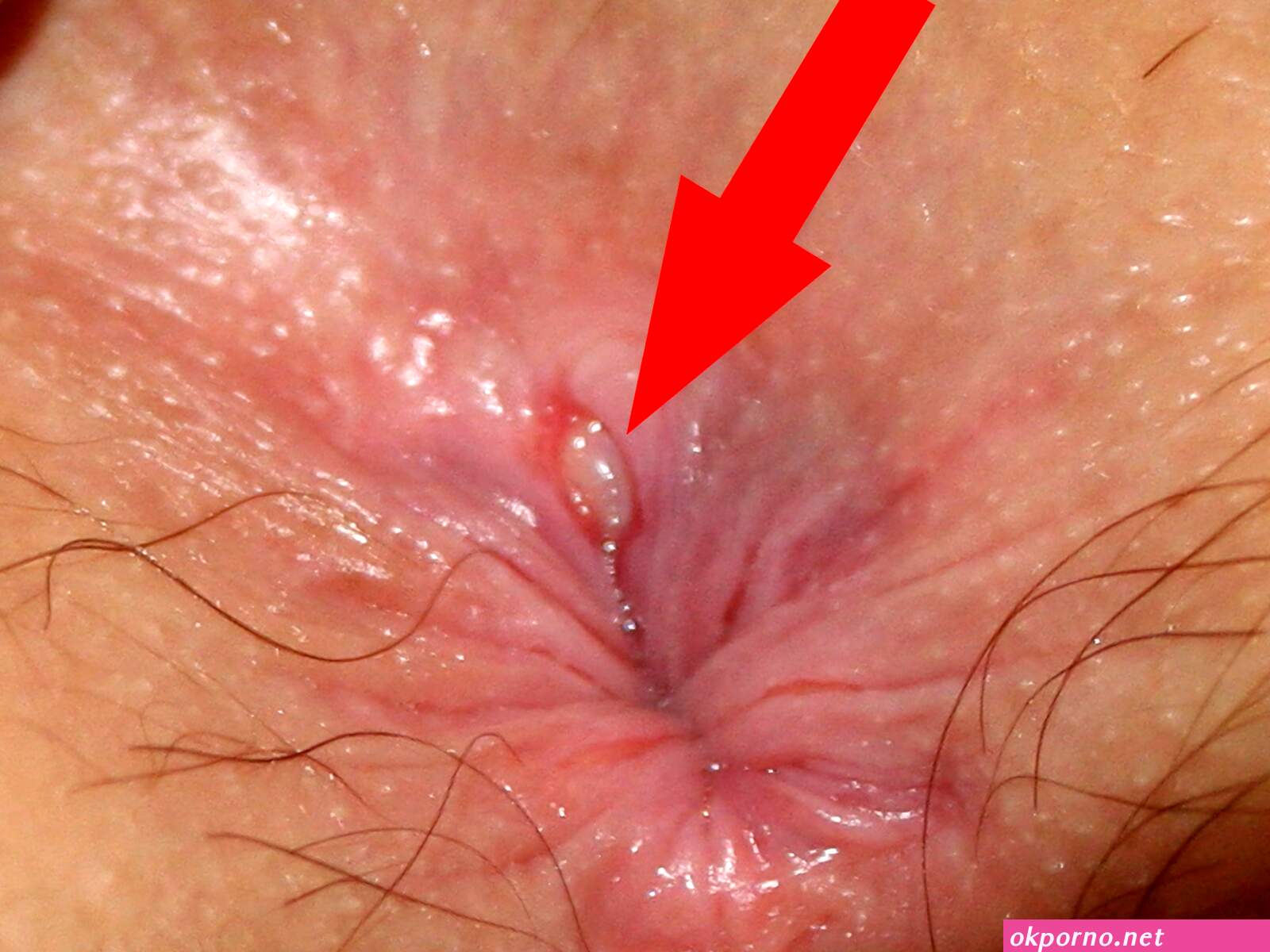 Anal
