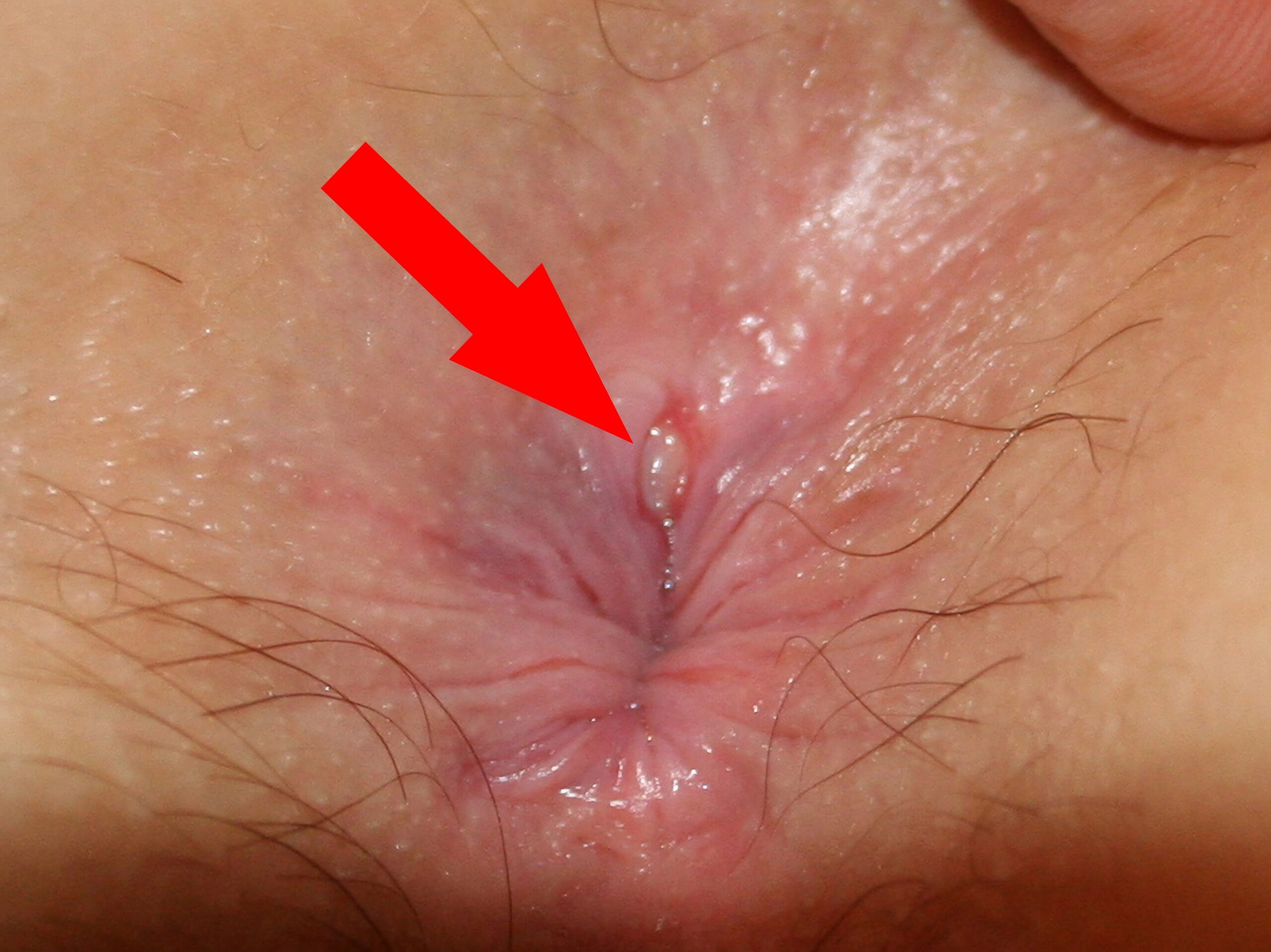 18 anal clft