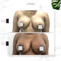 Breast Augmentation With Implants In Abuja