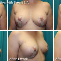 Natural breast augmentation with fat transfer in Wisconsin