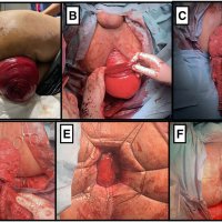 Emergency surgical strategy for incarcerated rectal prolapse