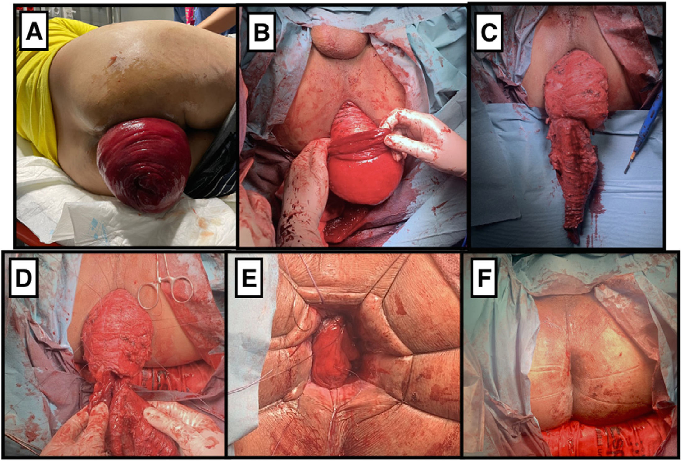 Prolapse anal
