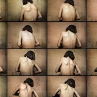 Could deep-brain stimulation be a cure for anorexia?
