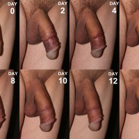 File:Circumcision 14 days.jpg