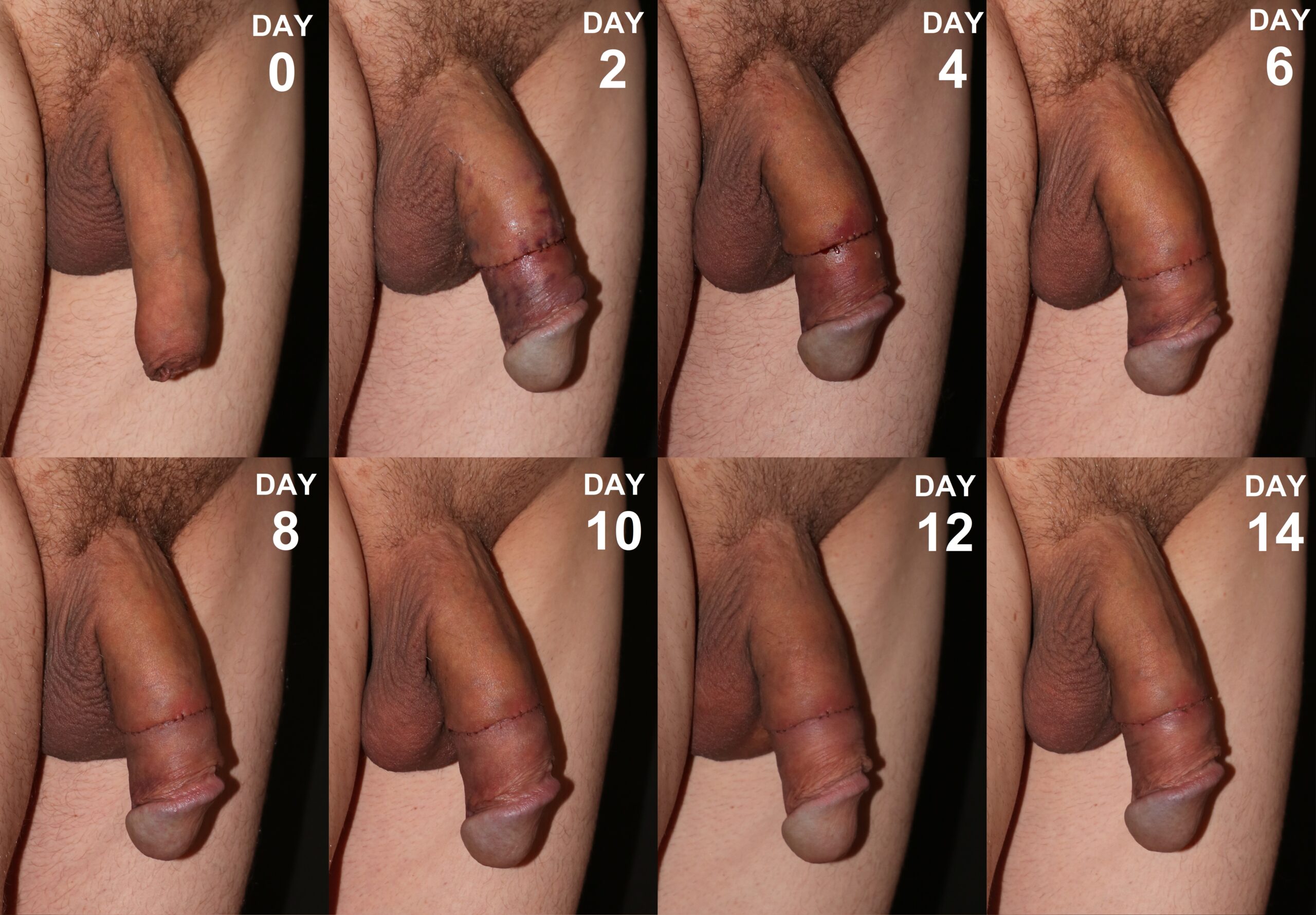 Nude new circumcision