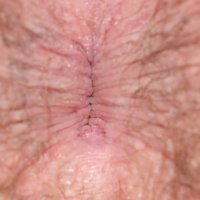 Bestand:Menselijke anus met gesloten sluitspier.jpg