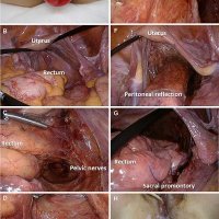 What is the recommended procedure for recurrent rectal prolapse? A retrospective cohort study in a single Japanese institution
