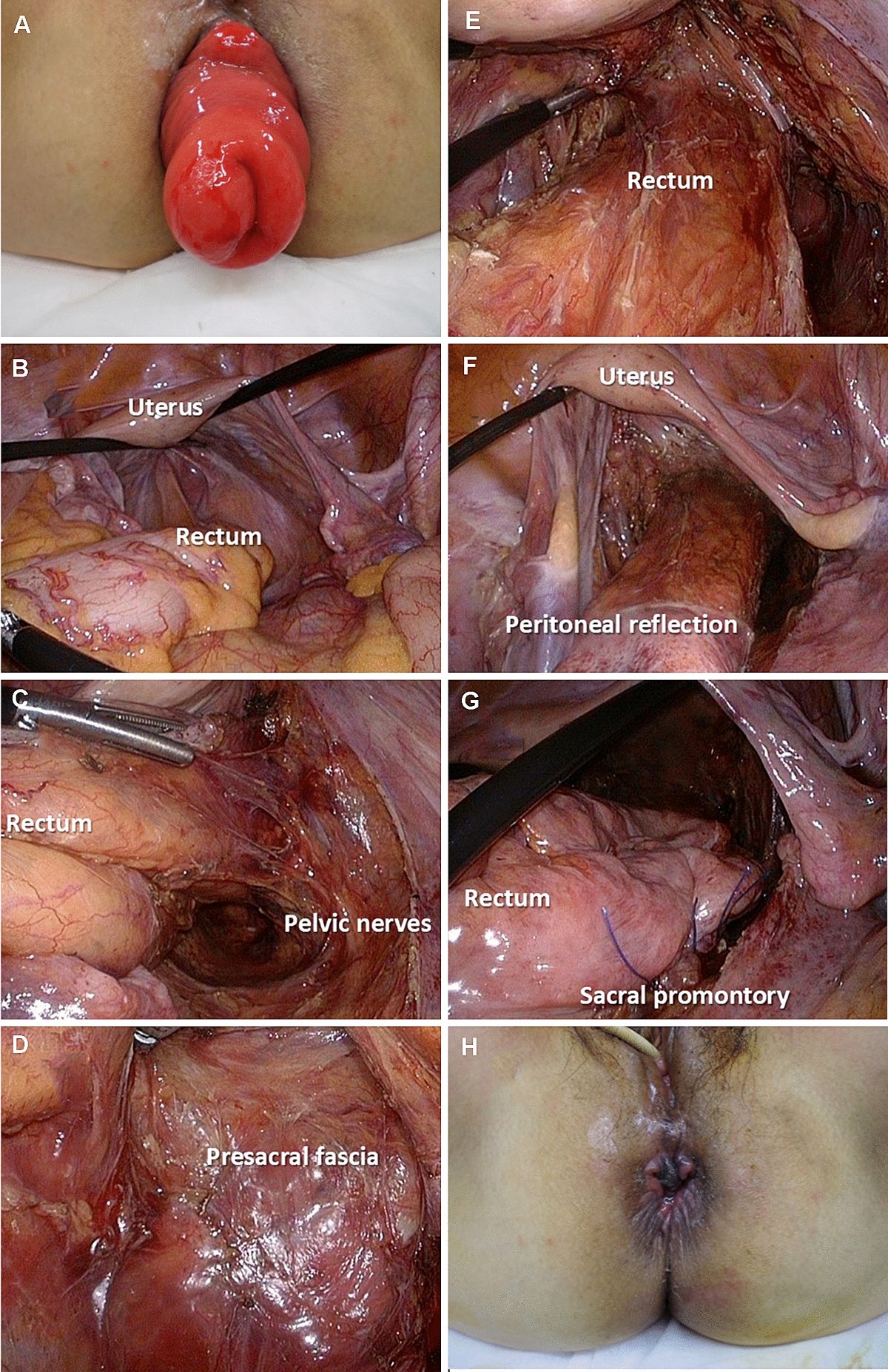 Repugnante prolapso anal