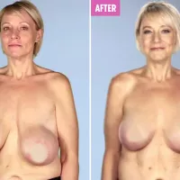 My boobs looked like cow udders and hung to my belly button until Botched docs transformed my life