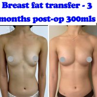 Breast Augmentation Small Implants: Top 3 Questions Answered